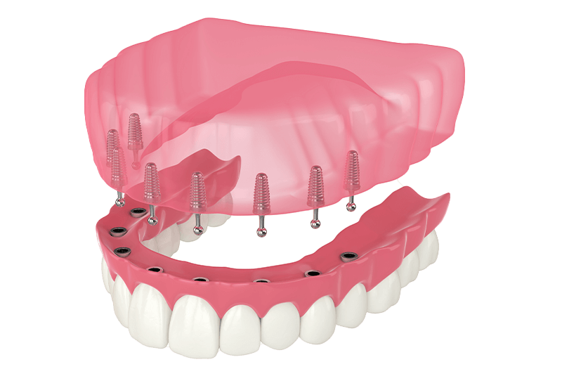snap on dentures