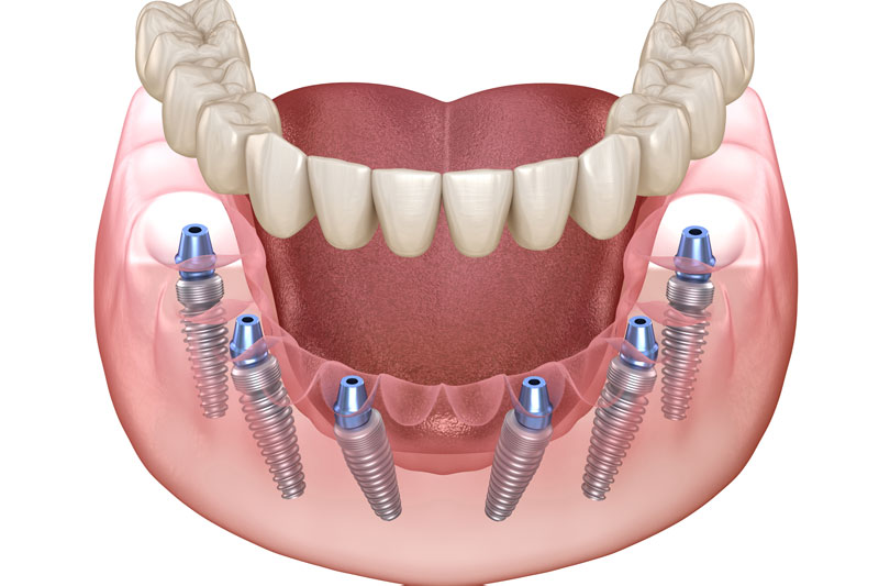 all on 6 dental implants with a full arch of teeth on top of the implants
